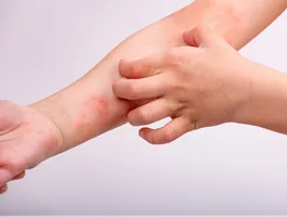 Dziecko drapie zaczerwienioną skórę na przedramieniu – swędzenie przy atopowym zapaleniu skóry