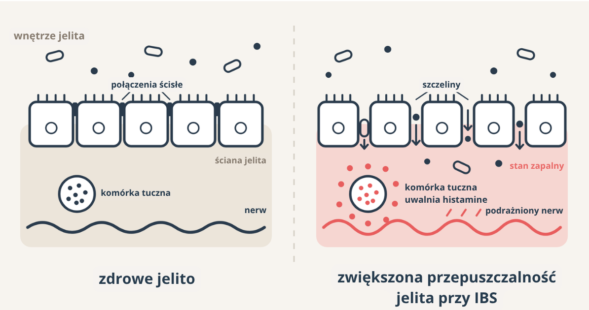 Porównanie zdrowego jelita i jelita przy IBS: rozluźnione połączenia ścisłe, komórka tuczna uwalniająca histaminę, stan zapalny i podrażniony nerw